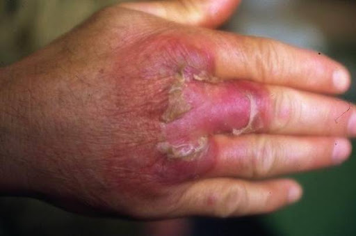 بیماری حمره (باد سرخ)